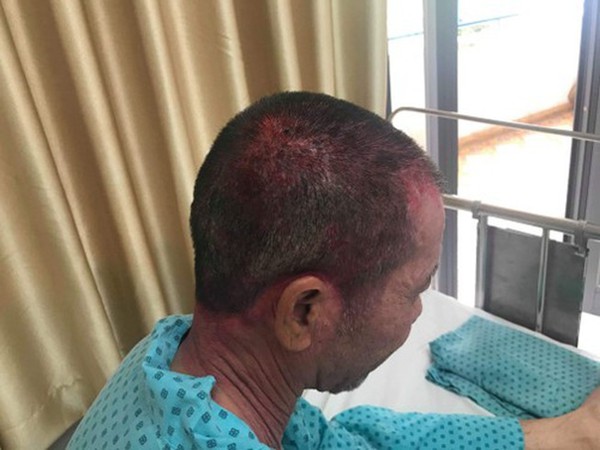 Người đàn ông trung niên nhập viện cấp cứu sau khi nhuộm tóc vì dị ứng nặng
