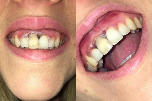 Sai sót khi tẩy trắng răng ở spa khiến cô gái bị hỏng phần nướu vĩnh viễn 